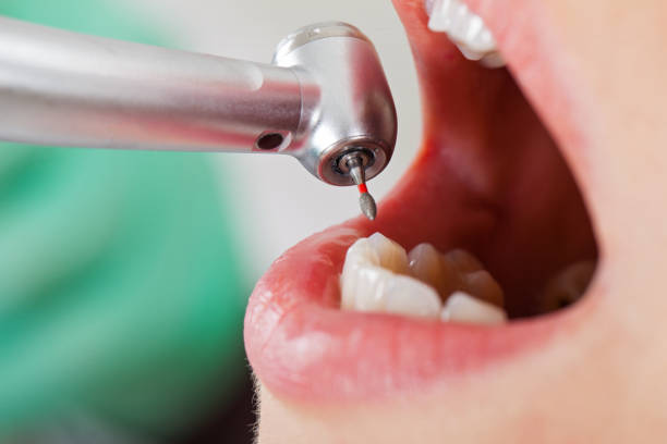 Best Emergency Root Canal Treatment in Kemah, TX